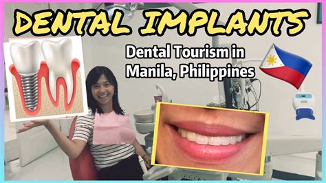 dental implants cost in the philippines